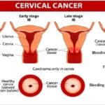 cervical cancer