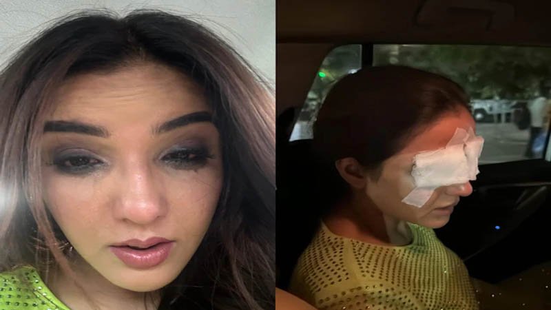 Jasmine Bhasin's Cornea Got Damaged